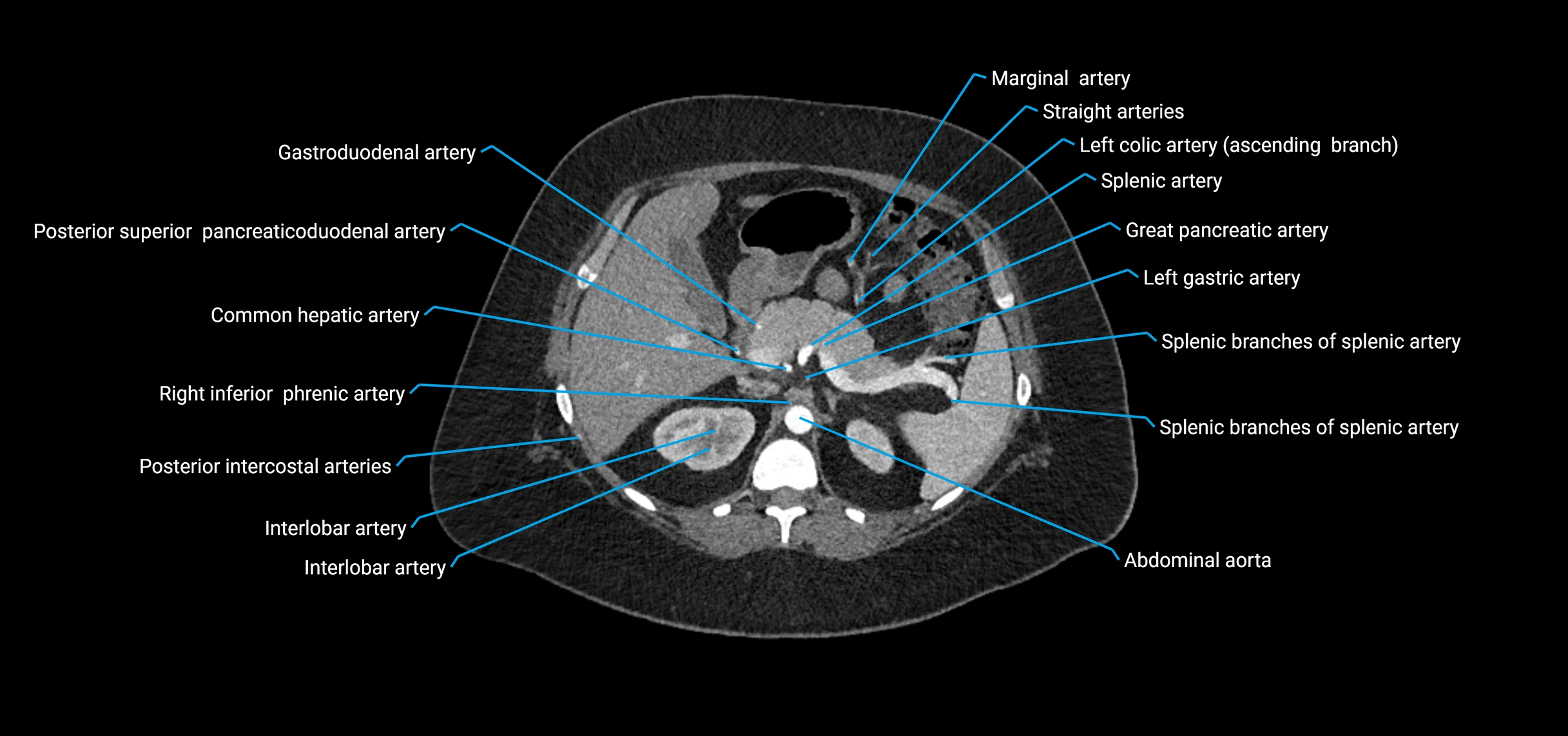 CTA abdomen axial cross sectional anatomy labelled image_51 (2).webp